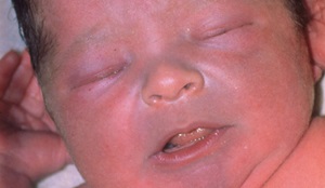 Водно-нітратна метгемоглобінемія або що таке  «блакитний синдром немовлят»